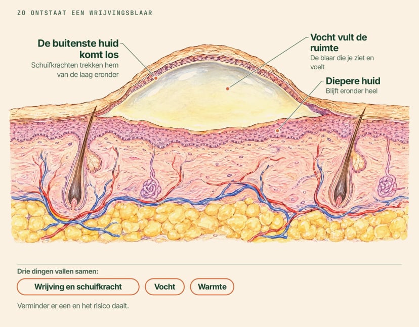 Doorsnede van de huid met een wrijvingsblaar, met labels: de buitenste huid komt los, vocht vult de ruimte en de diepere huid blijft eronder heel; wrijving en schuifkracht, vocht en warmte veroorzaken hem samen
