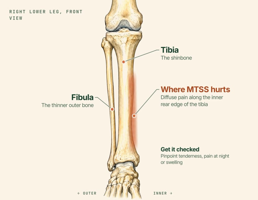 Anatomical illustration of the right lower leg from the front, labelled: the tibia or shinbone, the thinner fibula on the outer side, and a shaded band along the inner rear edge of the tibia where medial tibial stress syndrome causes diffuse pain