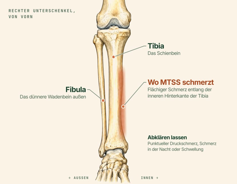 Anatomische Illustration des rechten Unterschenkels von vorn, beschriftet: Tibia (Schienbein), das dünnere Wadenbein außen und ein schattiertes Band entlang der inneren Hinterkante der Tibia, wo das Schienbeinkantensyndrom (MTSS) flächige Schmerzen verursacht