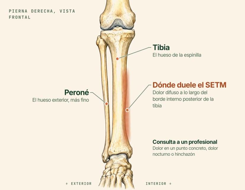 Ilustración anatómica de la pierna derecha vista de frente, con rótulos: la tibia, el peroné más fino en el lado exterior y una banda sombreada a lo largo del borde interno posterior de la tibia, donde el síndrome de estrés tibial medial causa dolor difuso