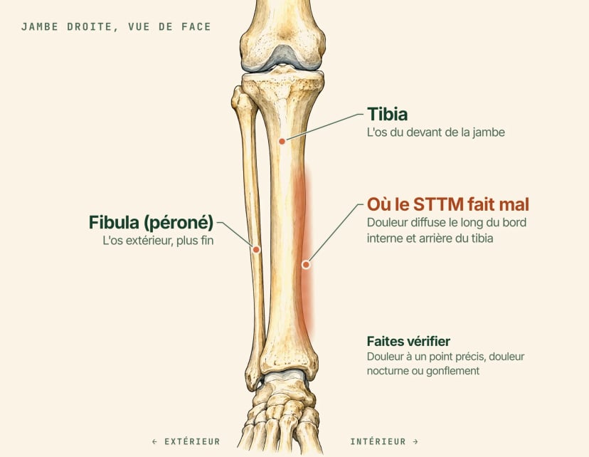 Illustration anatomique de la jambe droite vue de face, légendée : le tibia, la fibula plus fine du côté extérieur et une bande ombrée le long du bord interne et arrière du tibia, là où le syndrome de stress tibial médial provoque une douleur diffuse