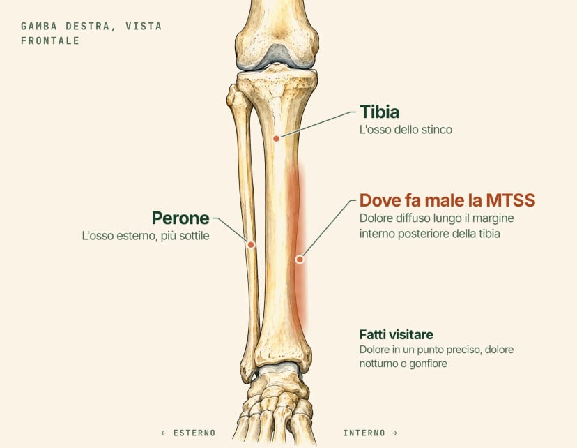 Illustrazione anatomica della gamba destra vista di fronte, con etichette: la tibia, il perone più sottile sul lato esterno e una fascia ombreggiata lungo il margine interno posteriore della tibia, dove la sindrome da stress tibiale mediale (MTSS) causa dolore diffuso