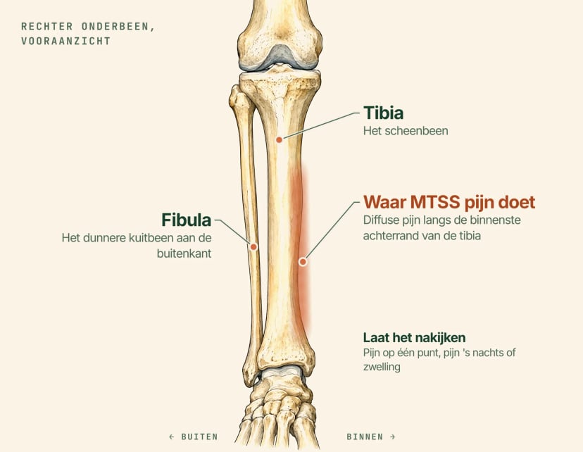Anatomische illustratie van het rechter onderbeen van voren, met labels: de tibia of het scheenbeen, het dunnere kuitbeen aan de buitenkant en een gearceerde band langs de binnenste achterrand van de tibia, waar MTSS diffuse pijn geeft