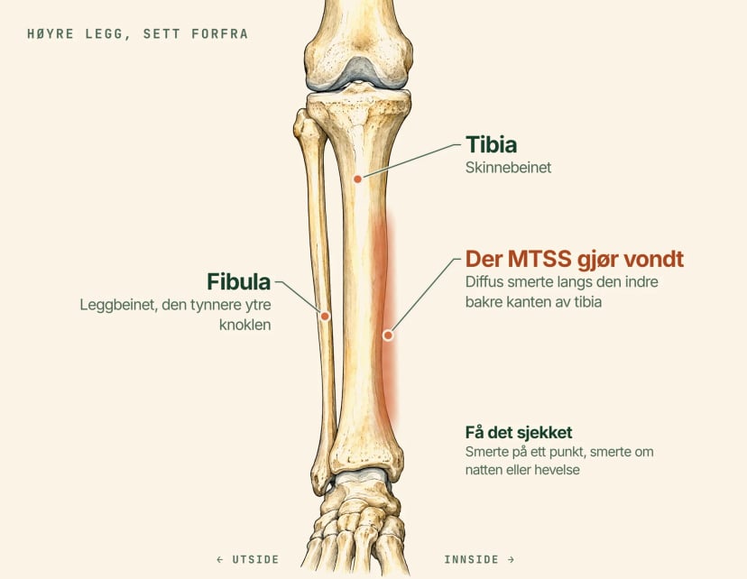 Anatomisk illustrasjon av høyre legg sett forfra, merket: tibia eller skinnebeinet, det tynnere leggbeinet på utsiden og et skravert bånd langs den indre bakre kanten av tibia, der MTSS gir diffus smerte
