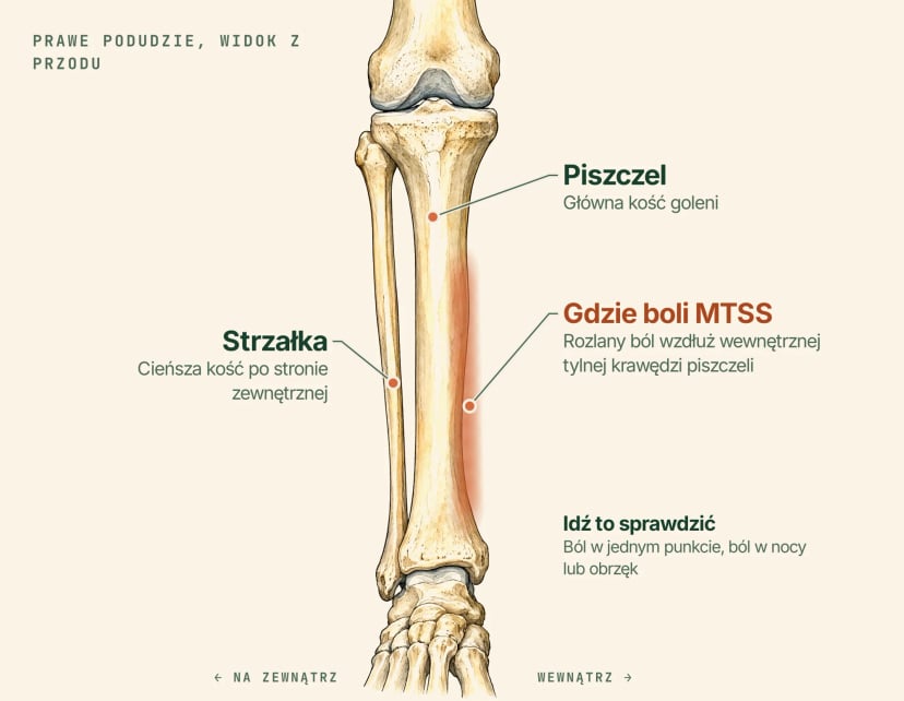 Ilustracja anatomiczna prawego podudzia od przodu z opisami: piszczel, cieńsza strzałka po stronie zewnętrznej i zacieniony pas wzdłuż wewnętrznej tylnej krawędzi piszczeli, gdzie MTSS powoduje rozlany ból