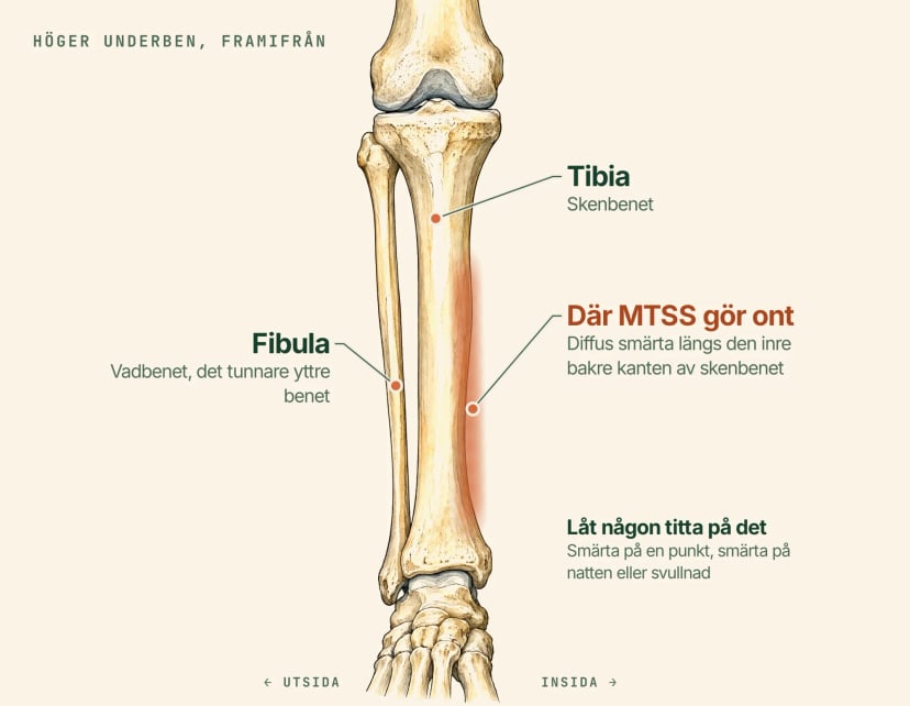 Anatomisk illustration av höger underben framifrån, märkt: tibia eller skenbenet, det tunnare vadbenet på utsidan och ett skuggat band längs den inre bakre kanten av skenbenet, där MTSS ger diffus smärta